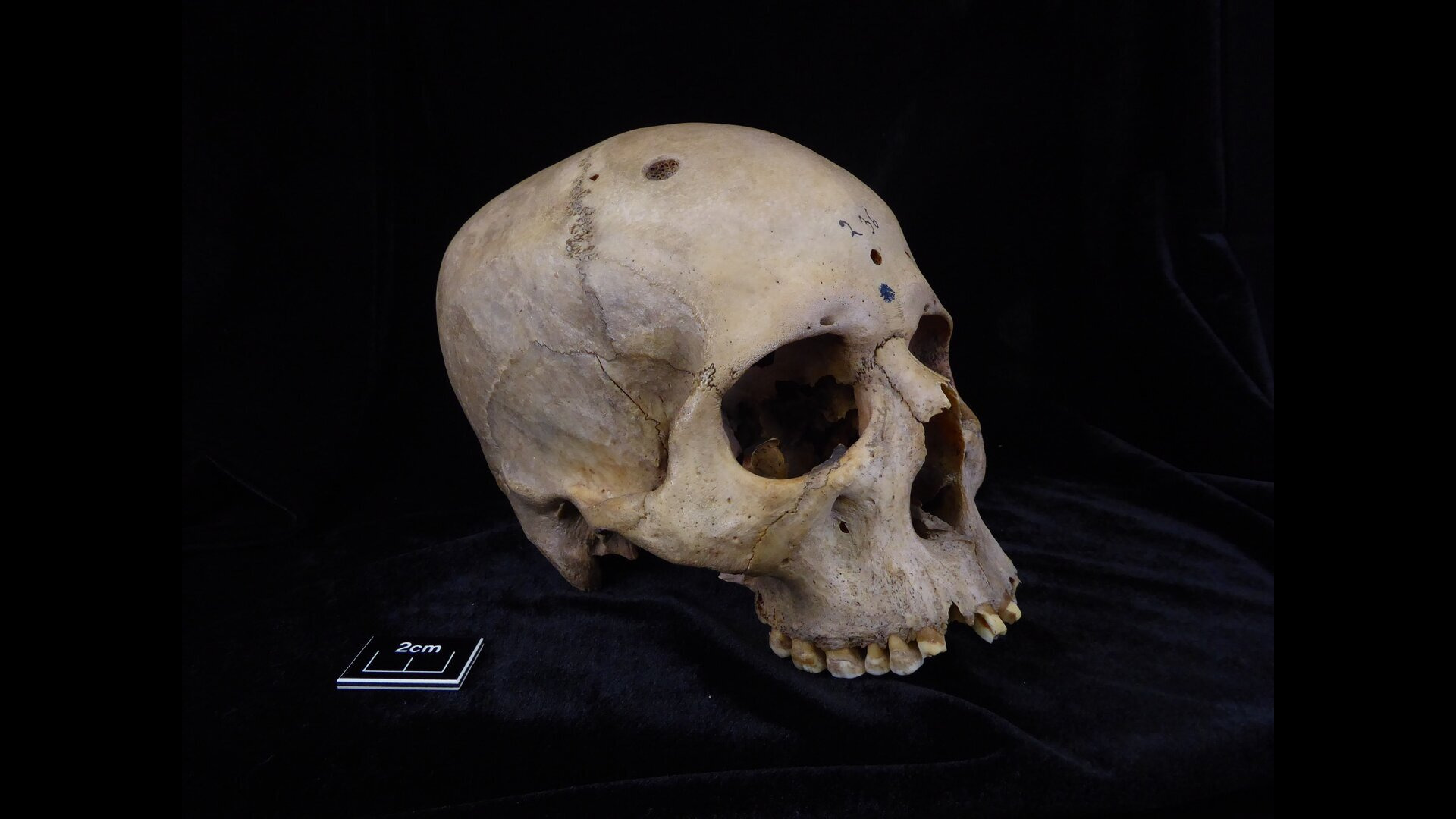 Un crâne « extraordinaire » fait allusion au traitement du cancer dans l’Égypte ancienne