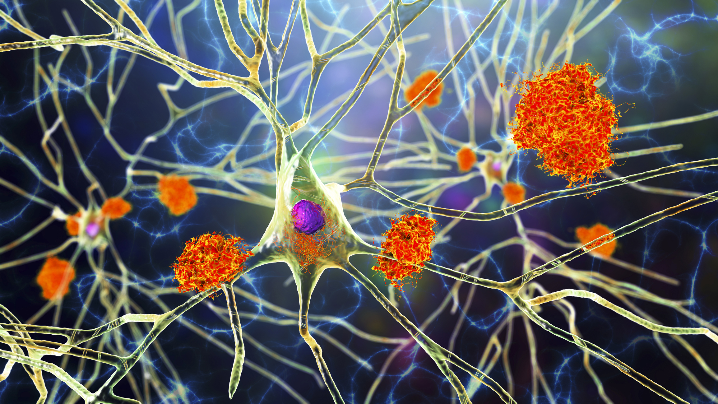 Alzheimer’s Breakthrough Could Halt Progression