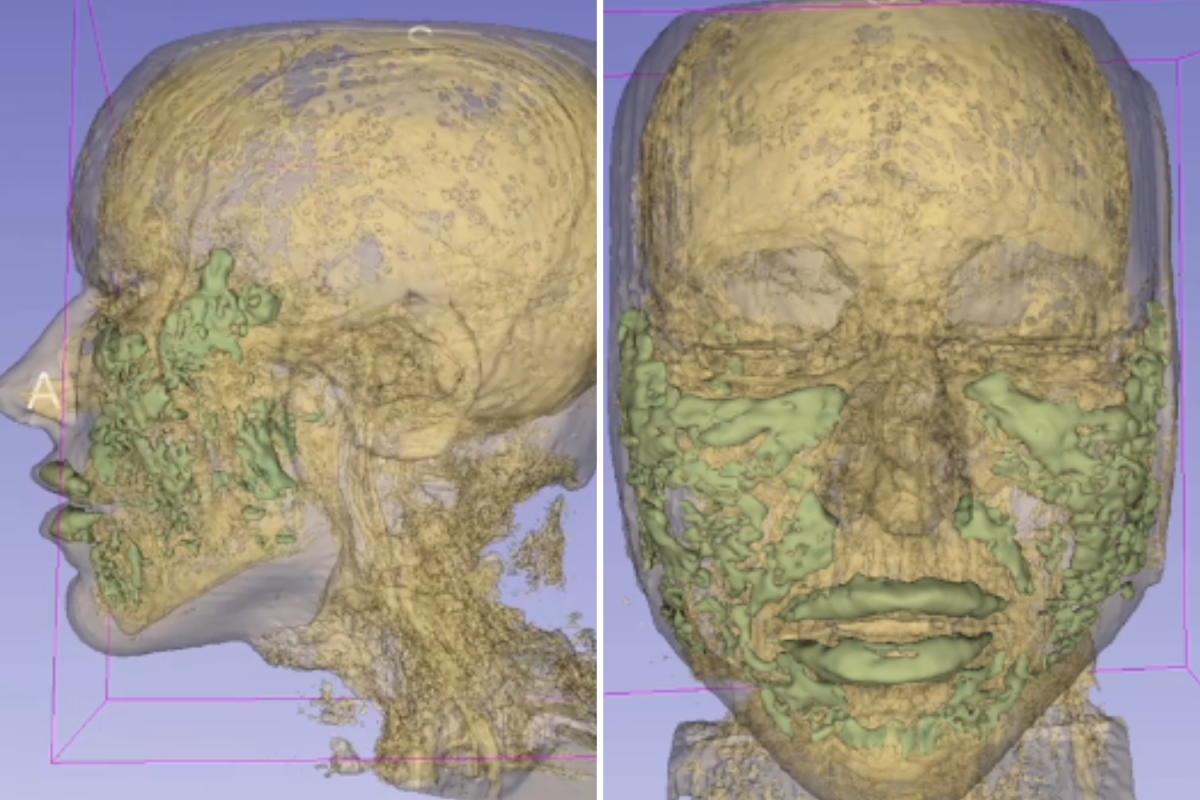Filler under MRI