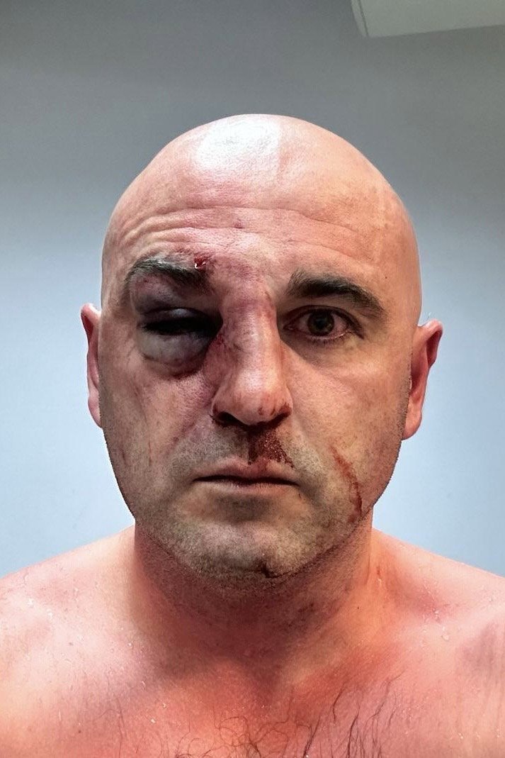 Georgian Opposition Politician After Assault