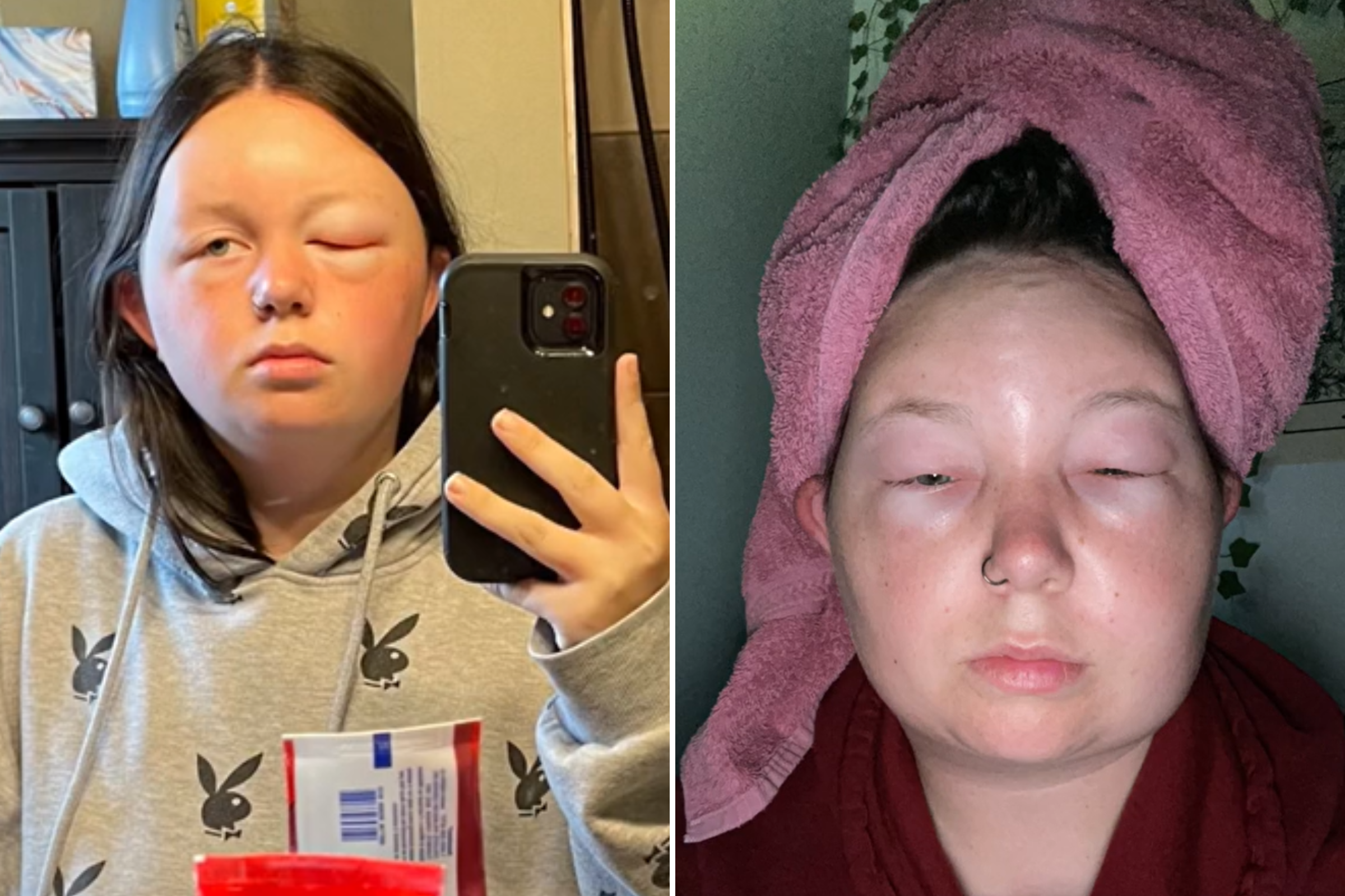 Woman Suffers Shock Allergic Reaction to Box Hair Dye: 'Never Again