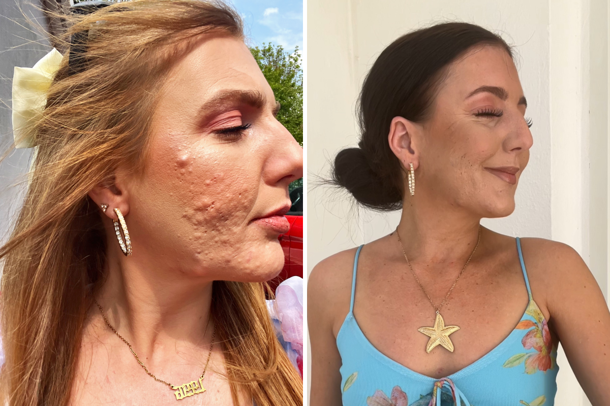 Woman With Painful Acne Documents 10 Months of 'Purging' on Accutane ...