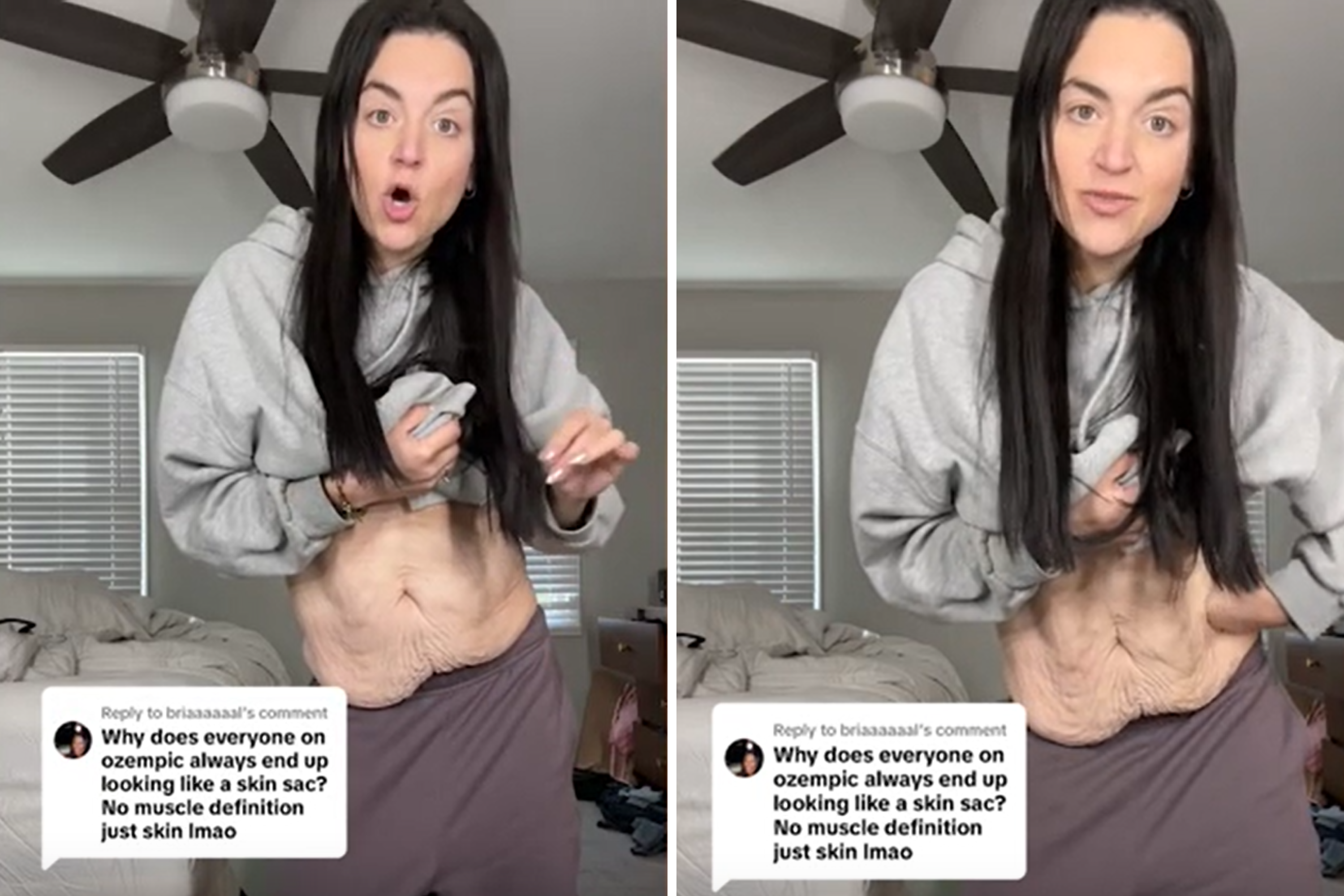 Woman Loses 160lbs on Ozempic, Then Shares Reality of Excess Skin