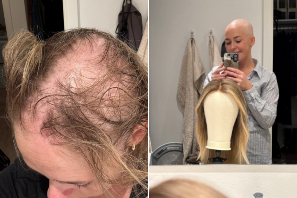 Viaje a la alopecia