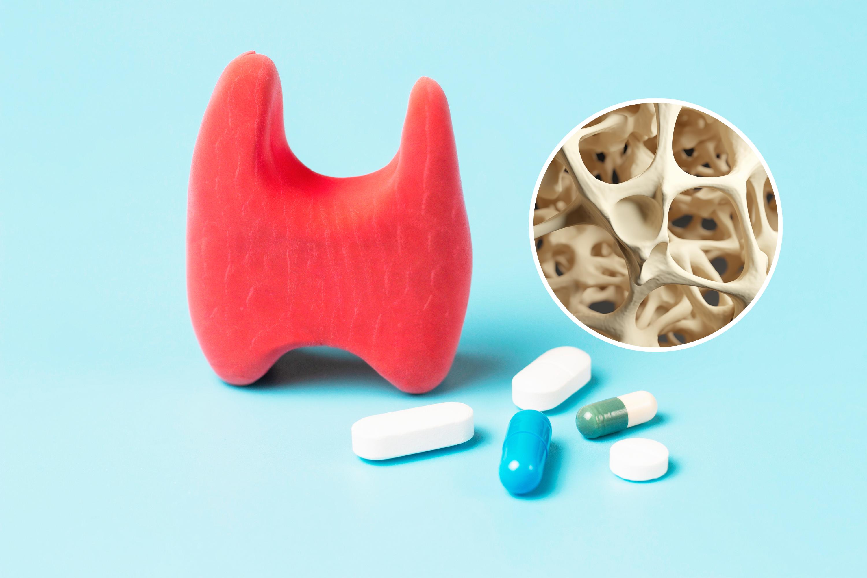 A red model of a thyroid is surrounded by pills, representing thyroid medication, with an image of a bone affected by osteoporosis overlayed. Getty Images / Canva