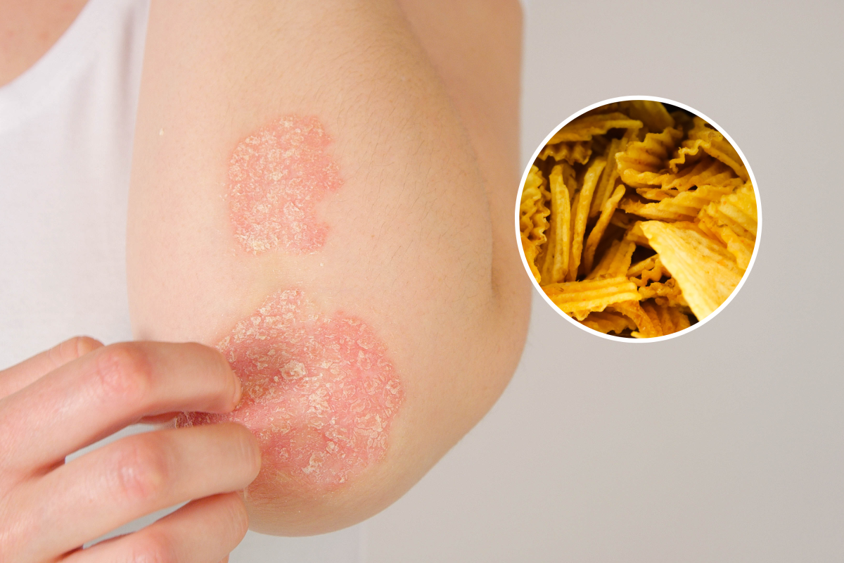 Psoriasis and chips