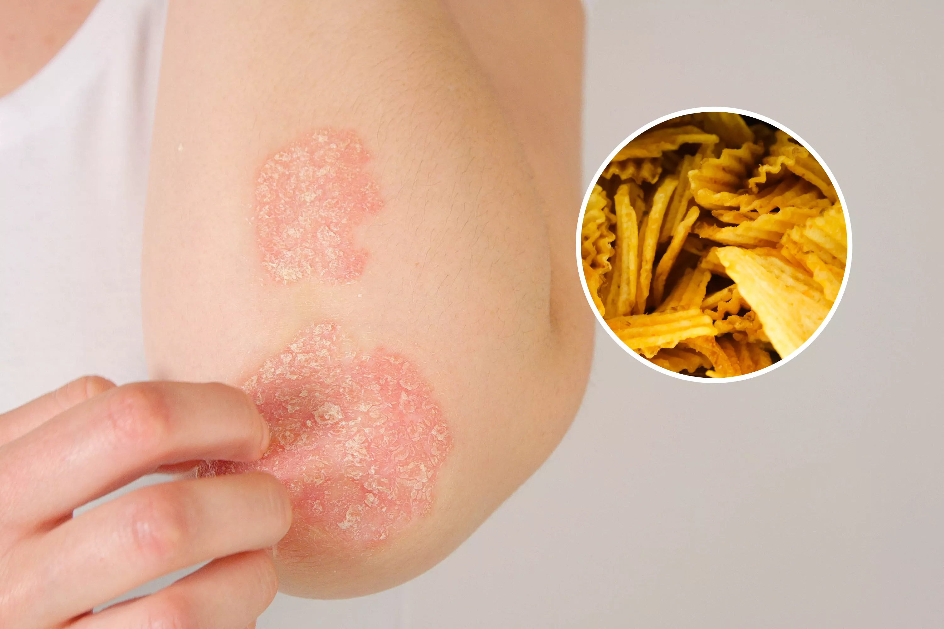 Common skin condition linked to ultra-processed food