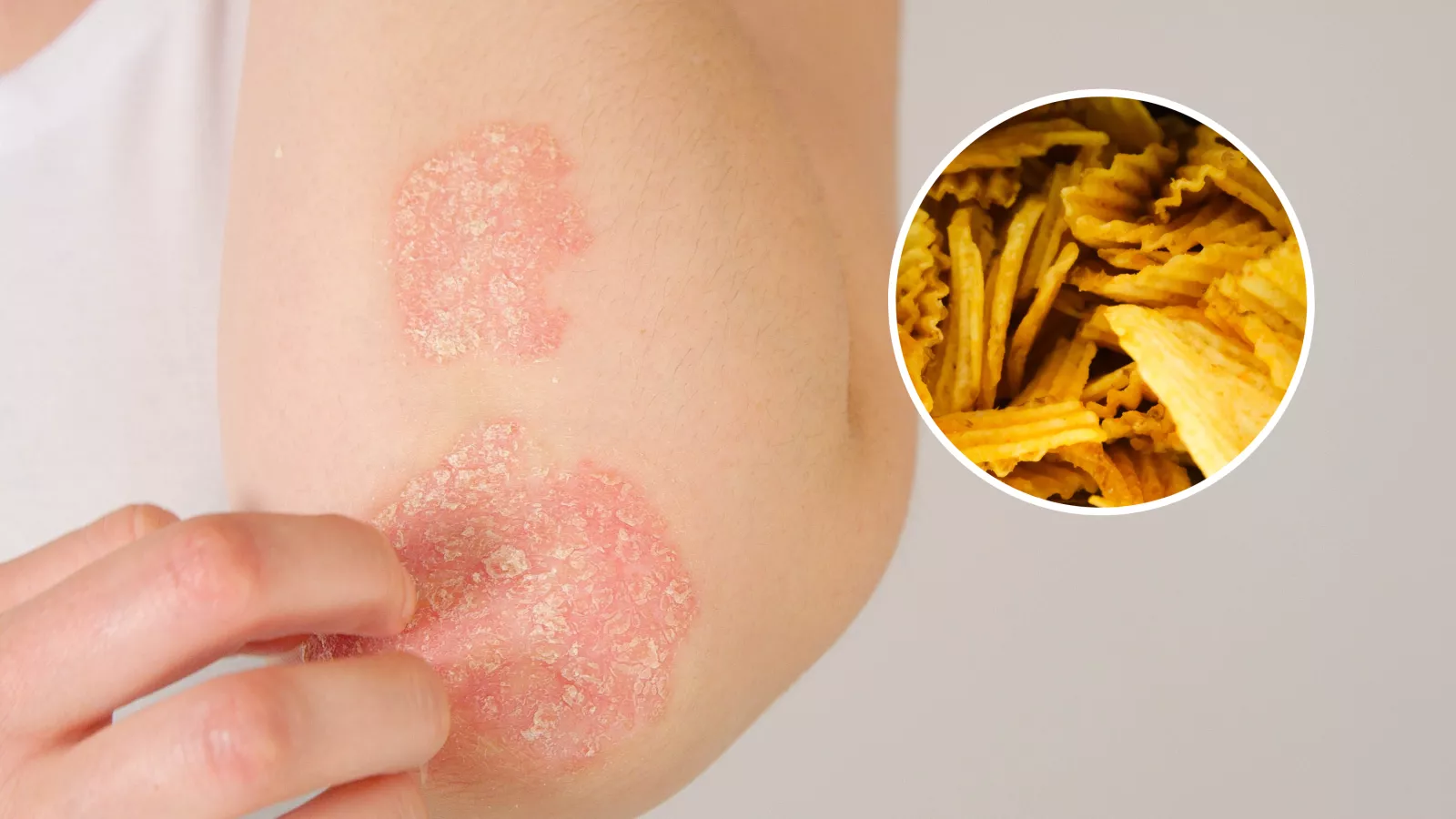 Common skin condition linked to ultra-processed food