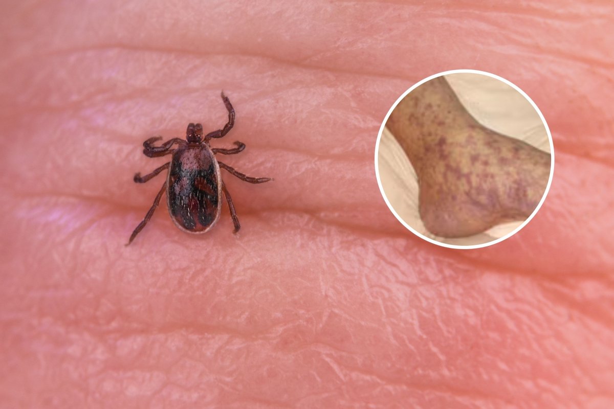 rocky mountain spotted fever