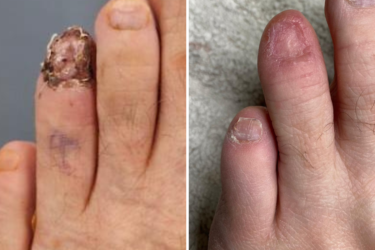 Toe nail