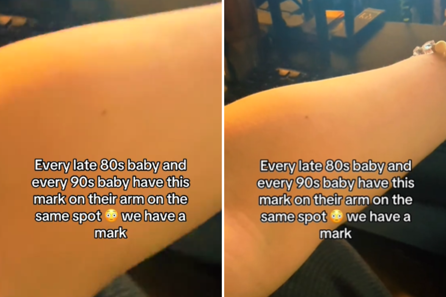 Do Millennials All Have This Mark on Their Arm?