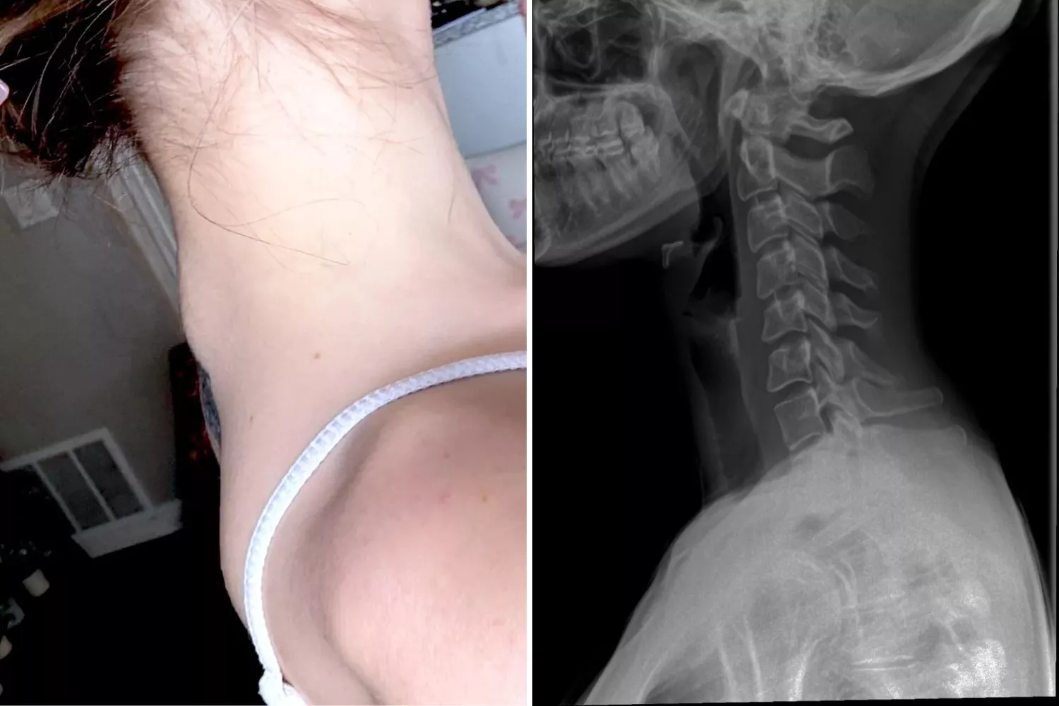 Gen Zer with rare condition gets otox injected -- then her spine destabilized