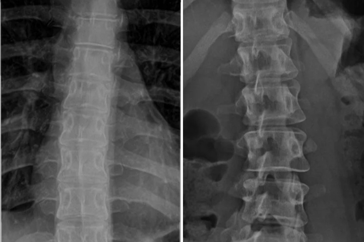 Botox x-ray