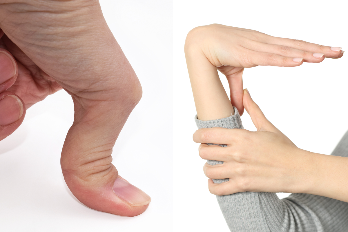 Hypermobility