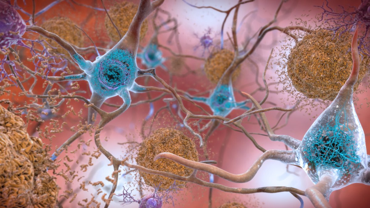 Illustration of Alzheimer’s affected brain