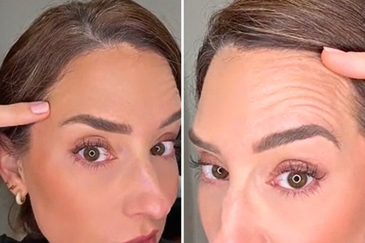 botox