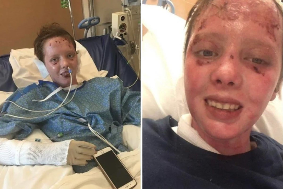 Gen Z Woman Survives Gas Explosion, Then She Shares Update 6 Years Later