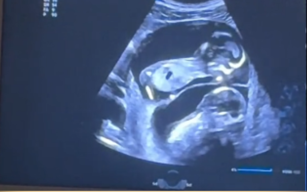 Pregnant Woman Carrying Twins Has Ultrasound&mdash;Shock at What It Reveals