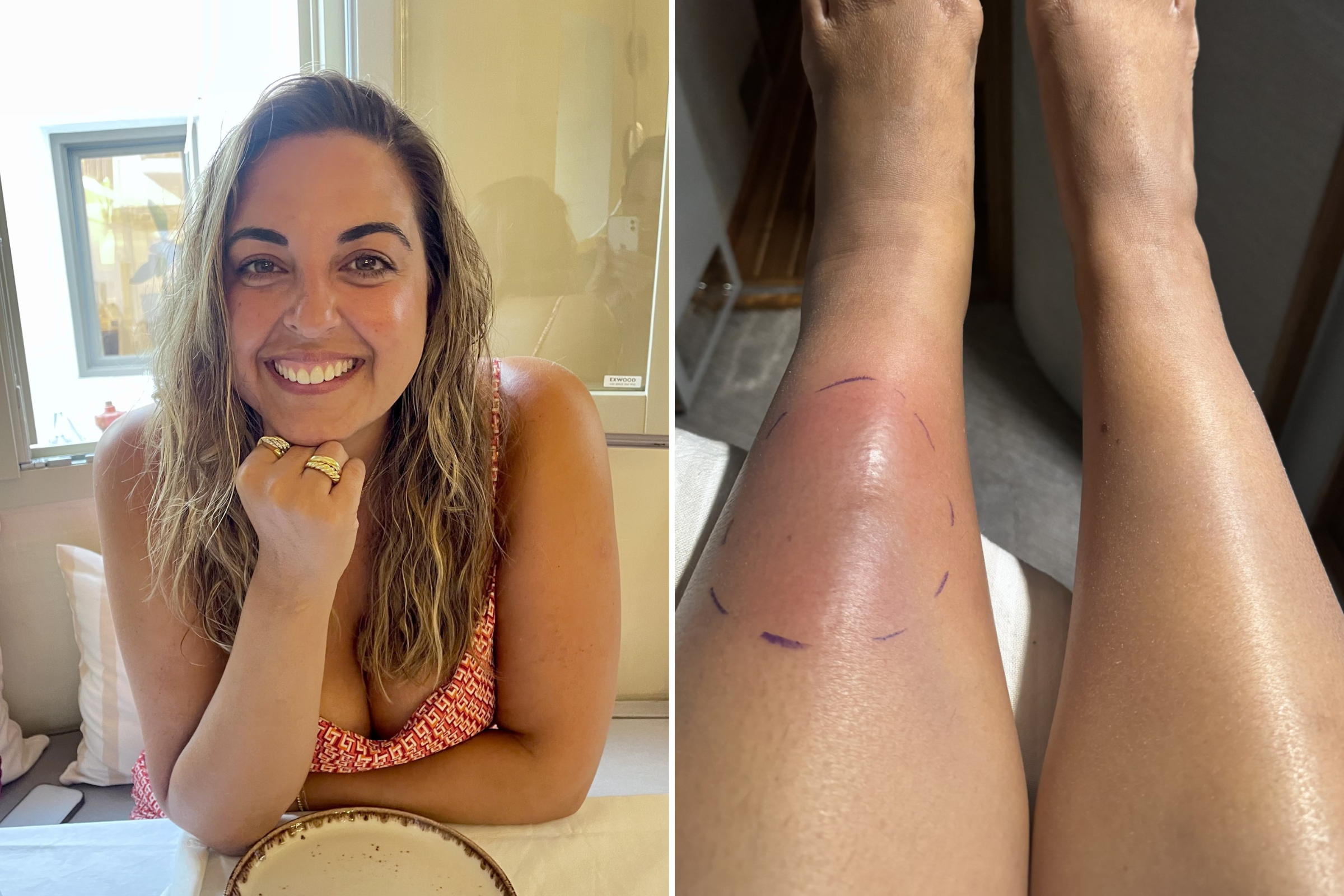 Woman Develops Lump in Her Leg&mdash;Cant Believe What Doctors Discover