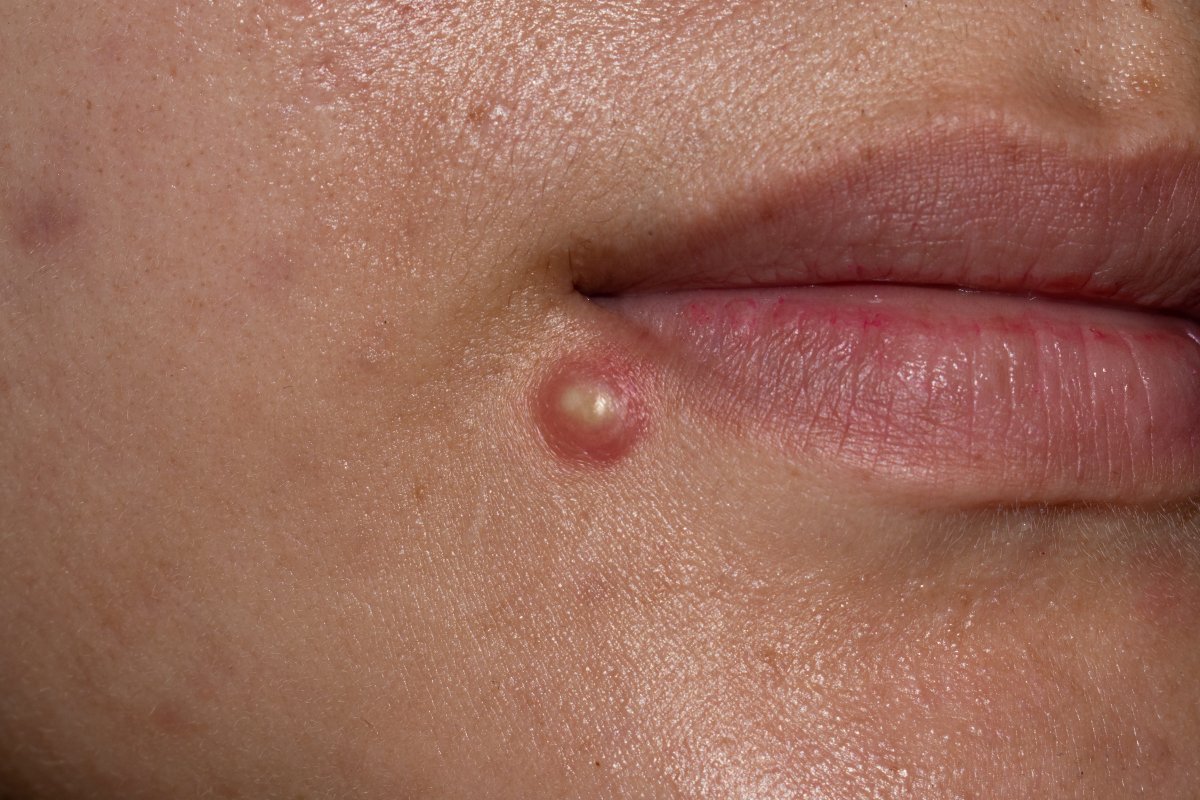 Woman with pimple 