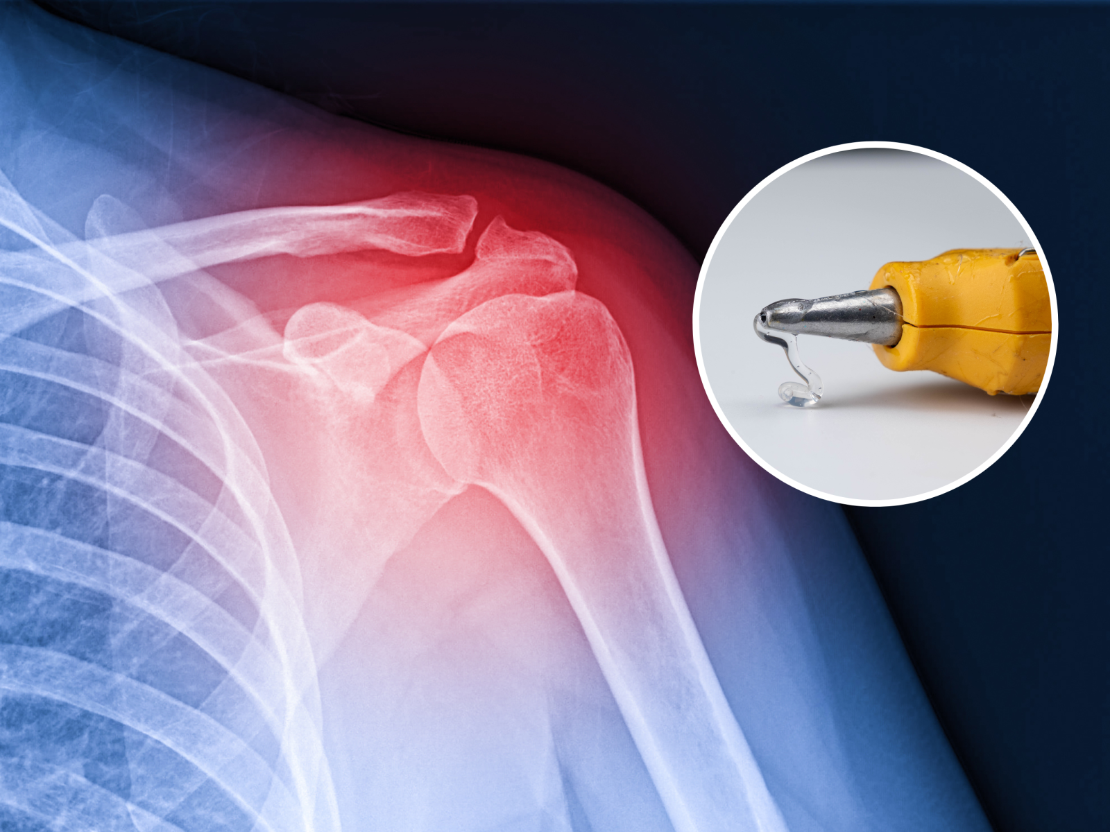 Scientists Can Now Use Glue Gun To Repair Broken Bones - Newsweek