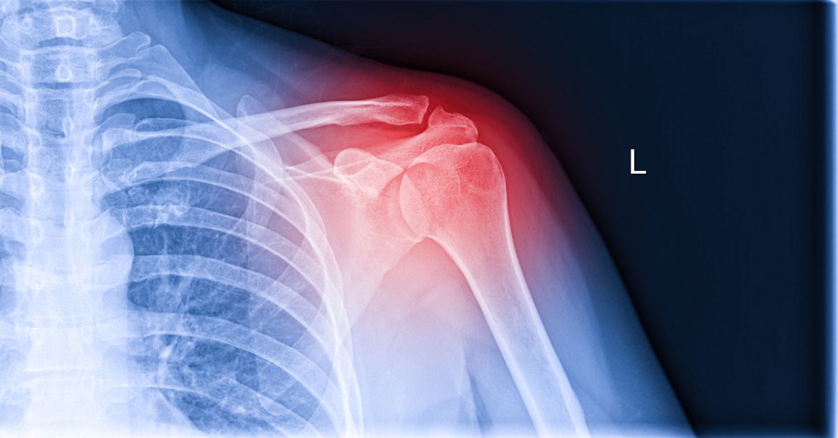 x ray bones