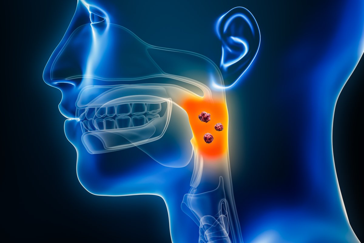 Cancro alla testa e al collo