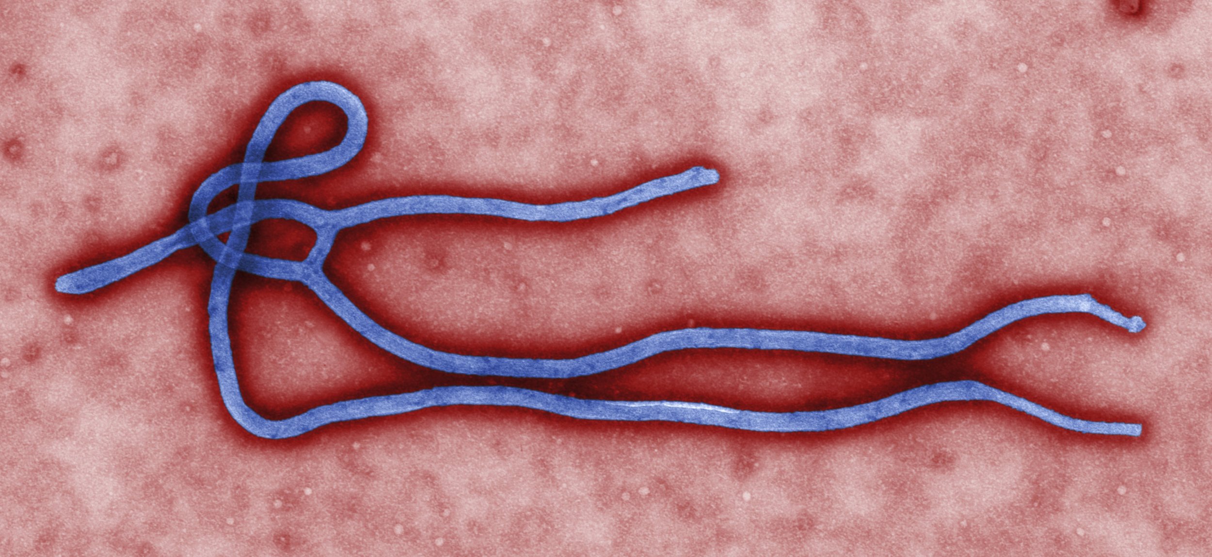 Scottish Nurse Treated For Ebola Complications In Critically Ill Condition