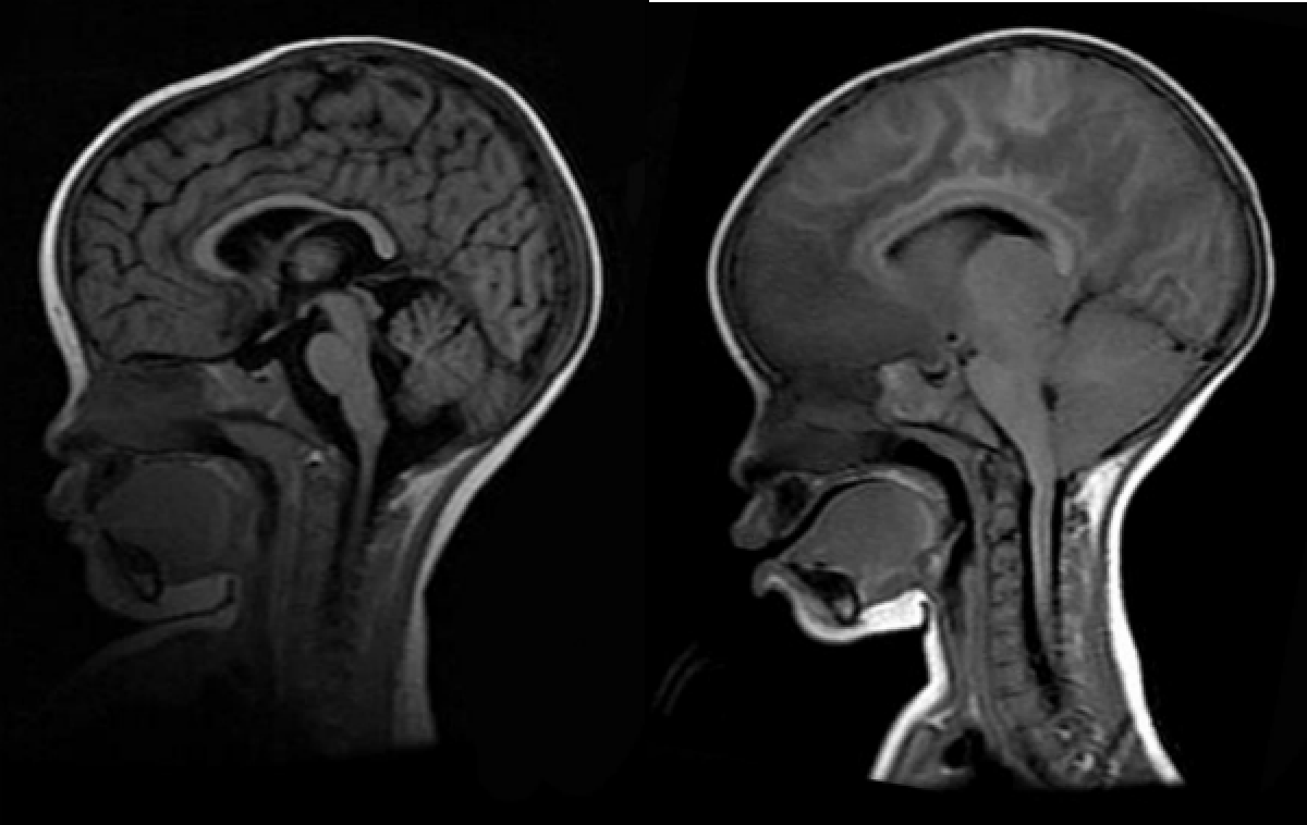 Cerebral-Malaria-MRIs
