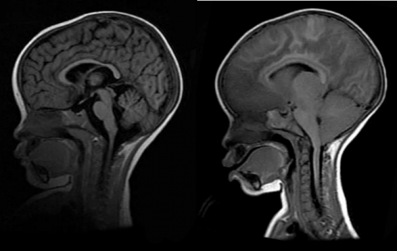 Cerebral-Malaria-MRIs