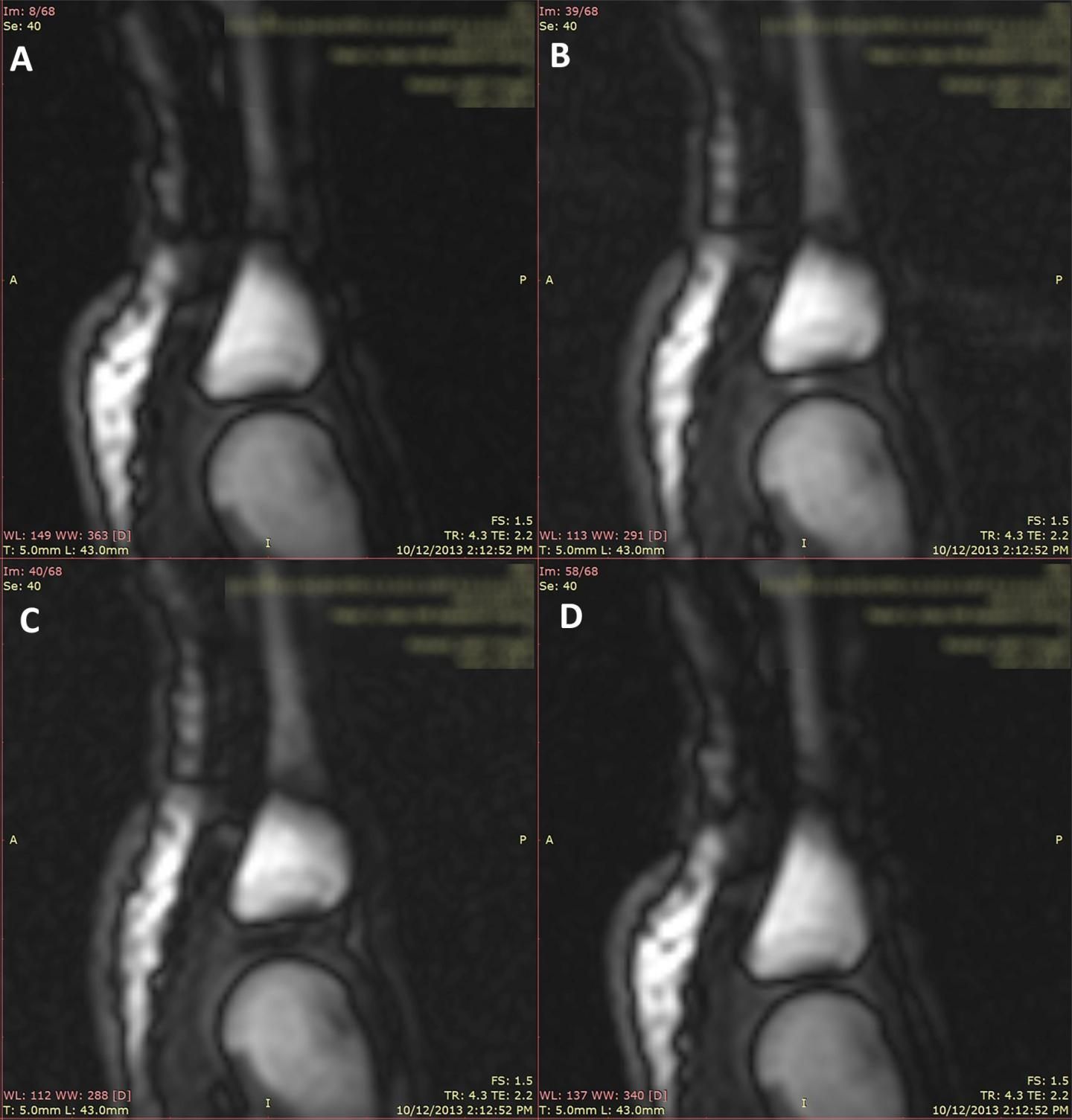 ventil uhyre Vænne sig til Video: Study Finally Shows Why Joints Crack