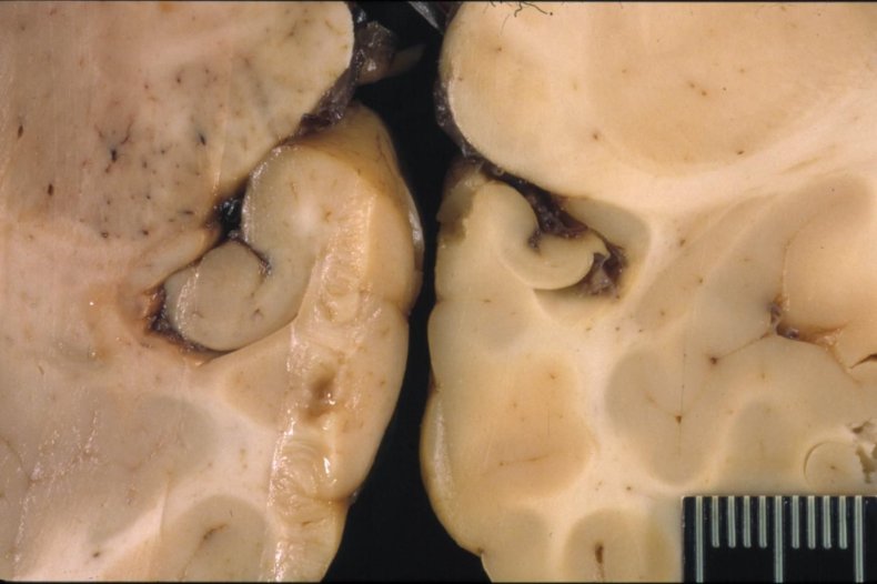 seal-brain-damage seal-brain-damage