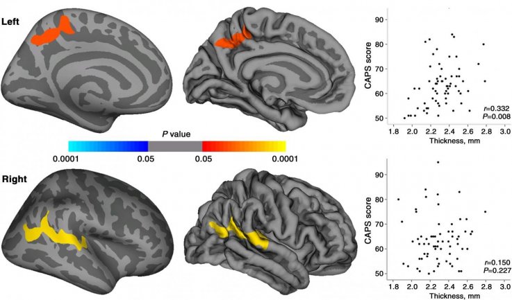 Images of PTSD Brains Images of PTSD Brains