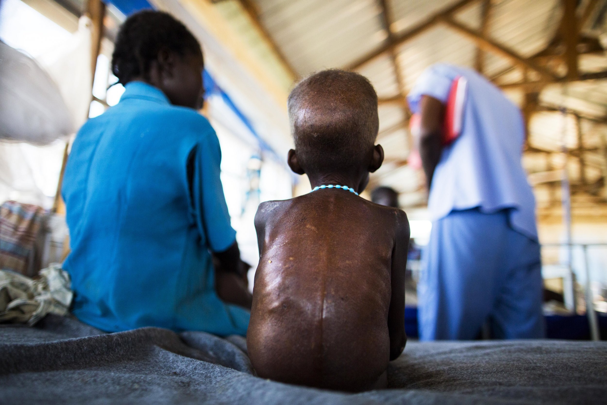 A South Sudanese boy with severe malnutrition rests in hospital.