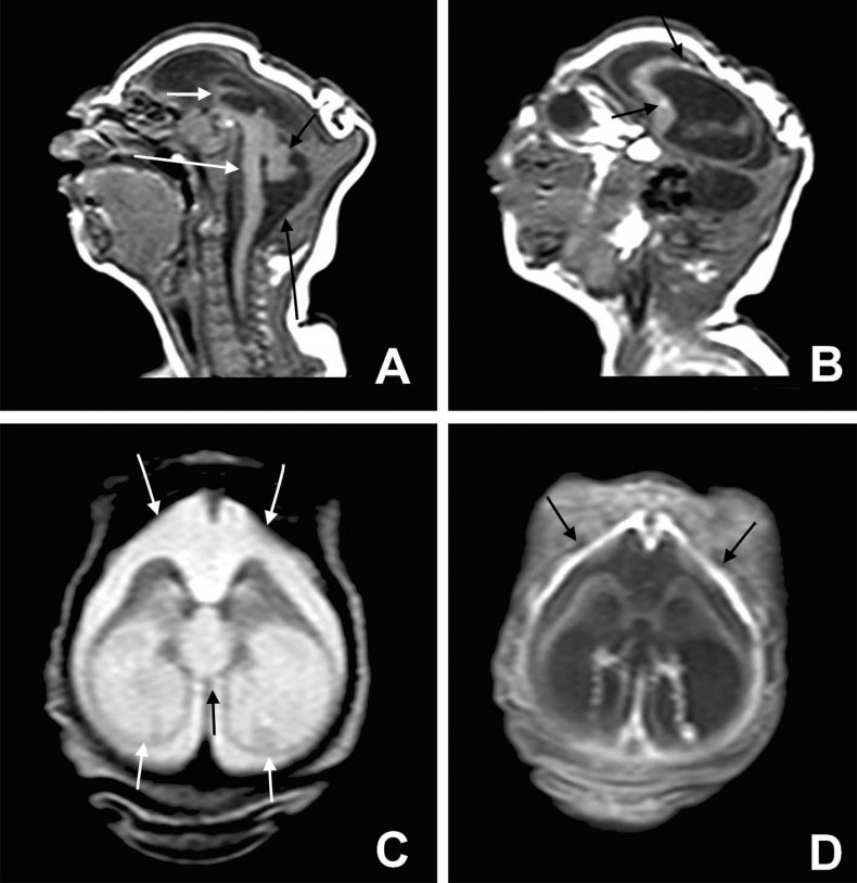 severe microcephaly