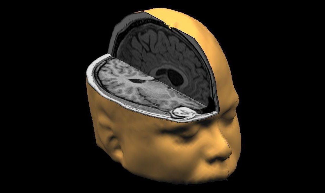 brainprint brain scan dyslexia binghampton