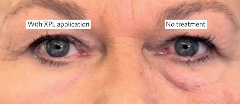 anti-aging second skin botox