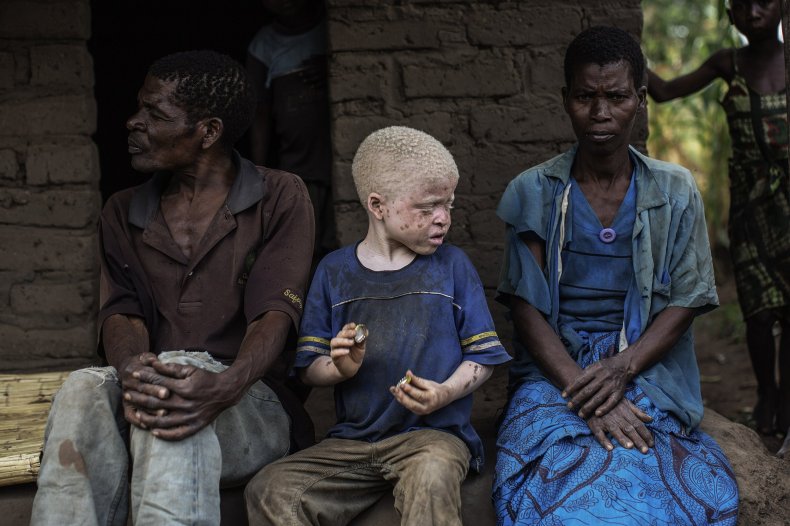 Malawian albino child with parents