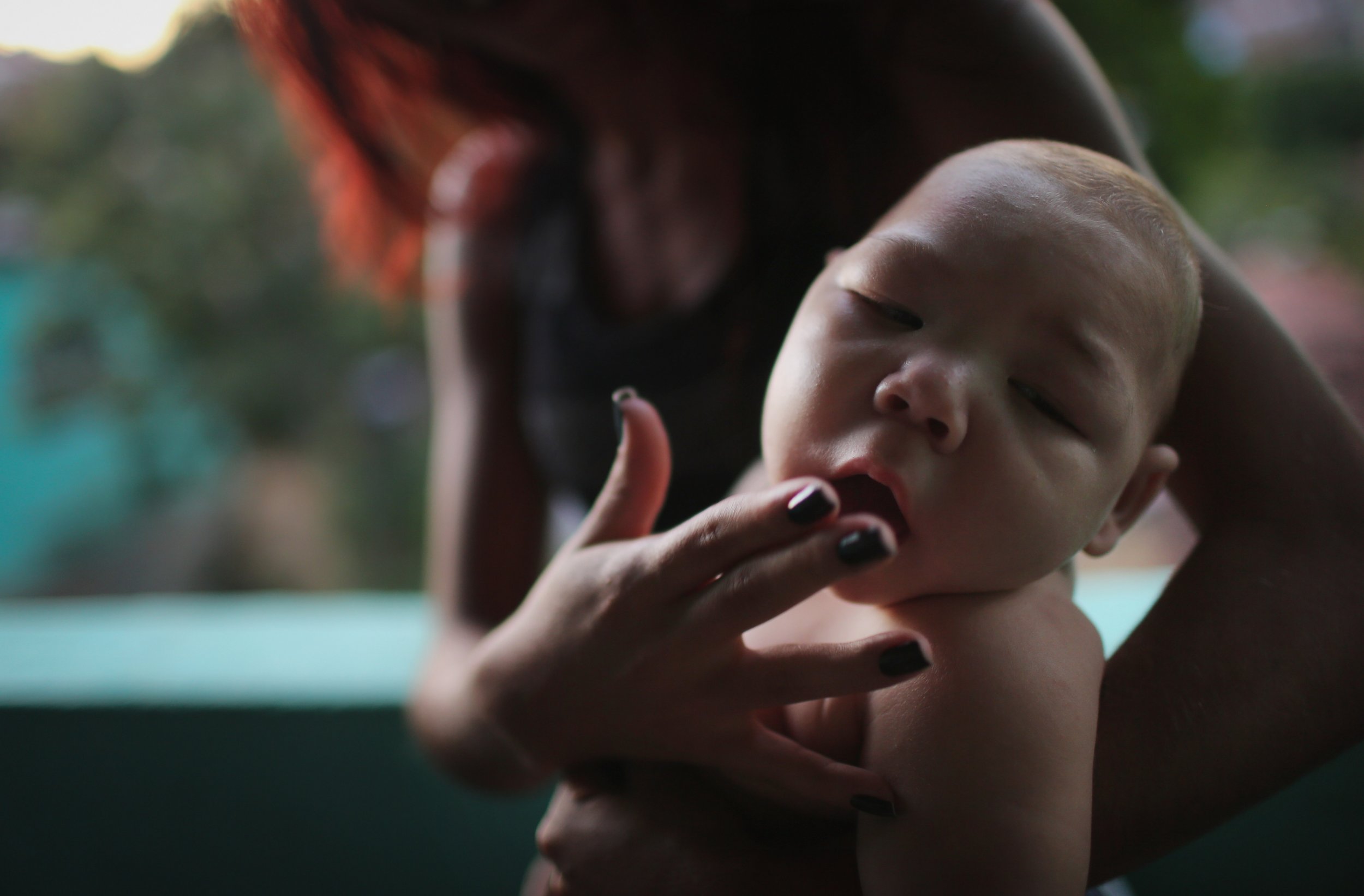 Brazil microcephaly baby