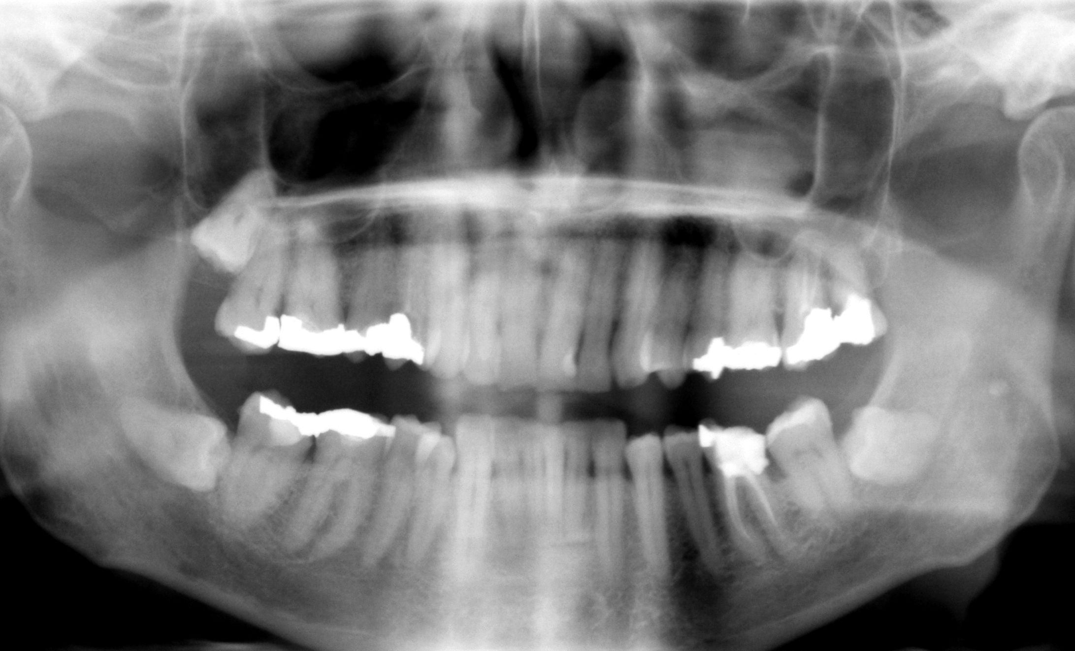 stem cell teeth cavity root canal