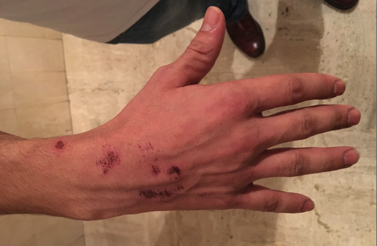 Said Nait's hand injuries after he jumped the promenade wall