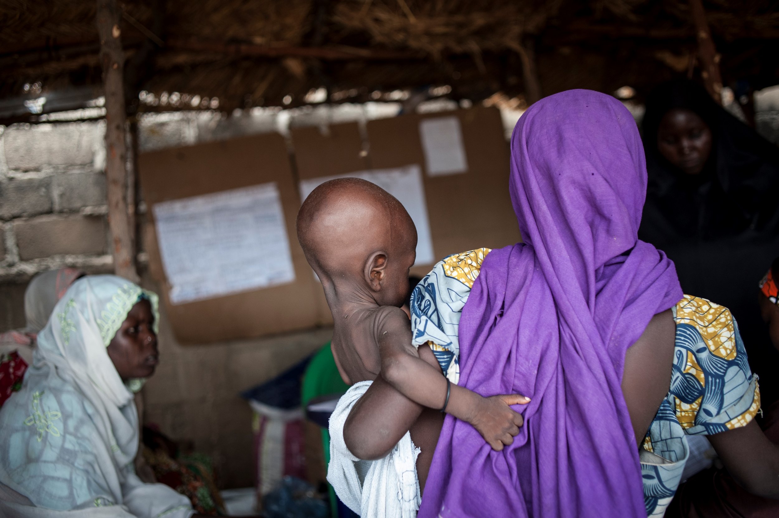 Nigeria malnourished child