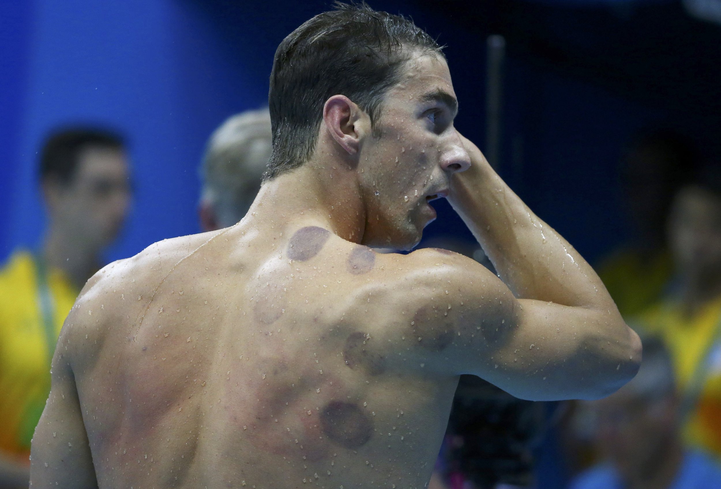 Phelps Cupping