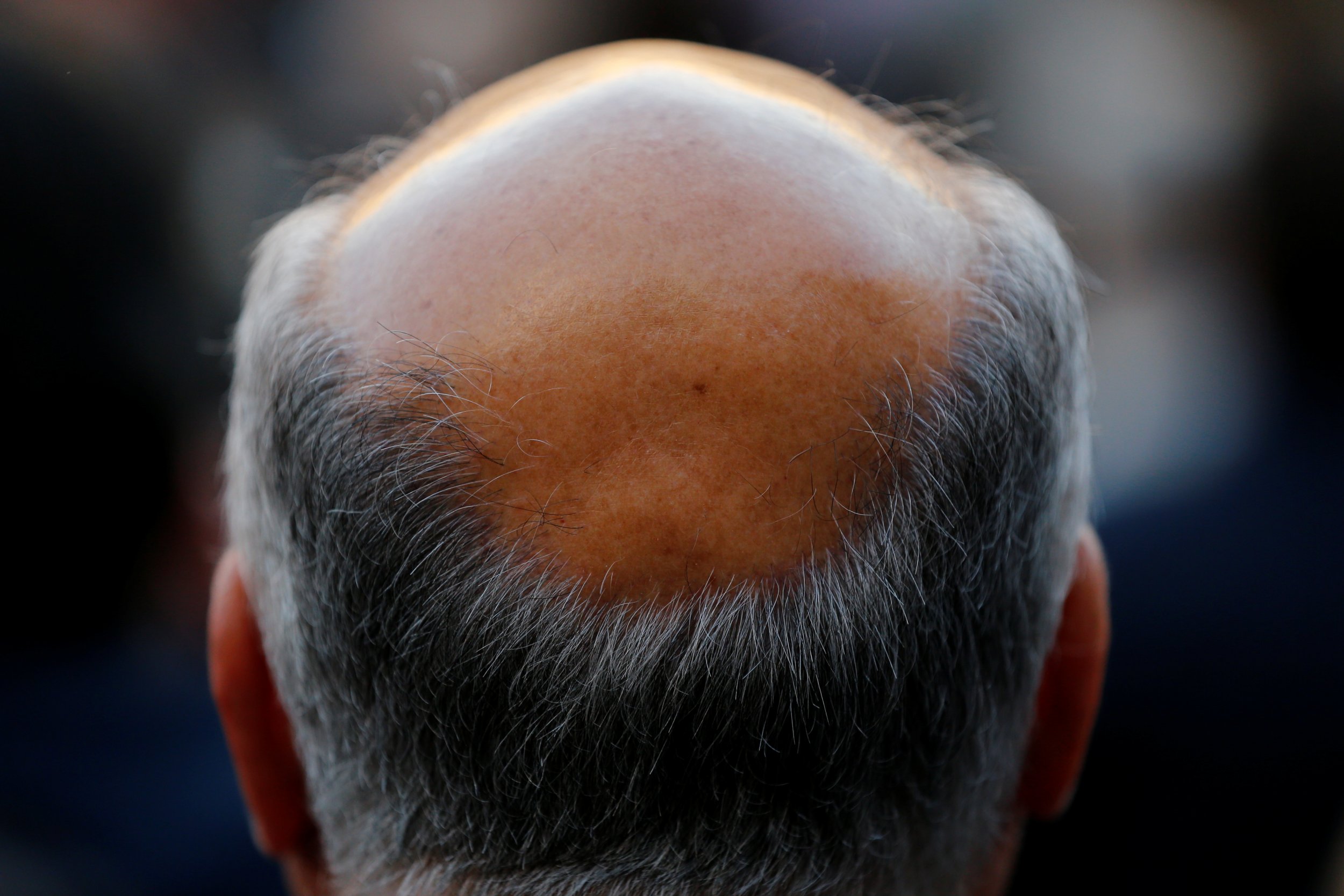 male-pattern-baldness-stages-slidesharedocs