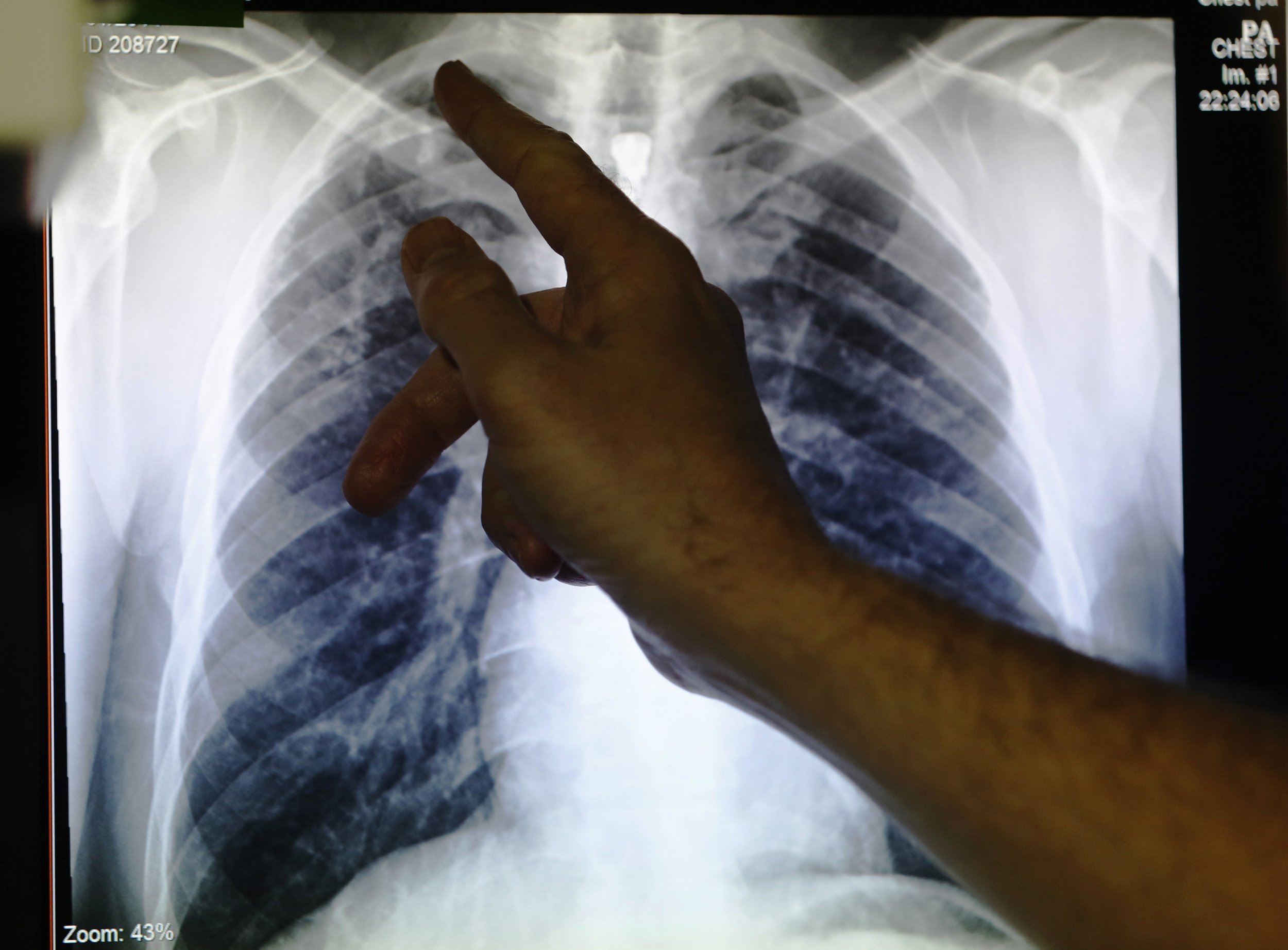 Lungs infected with TB