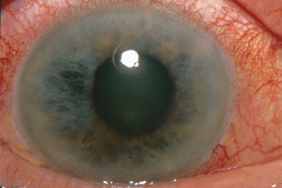 Glaucoma eye