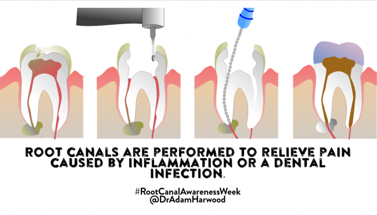 root canal awareness week 1 root canal awareness week 1