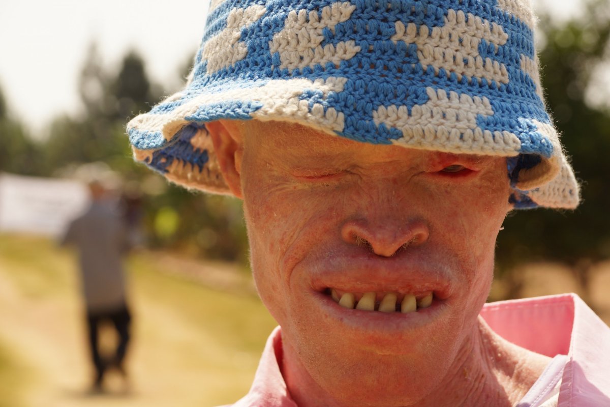 Tanzania Albinism Collective 2