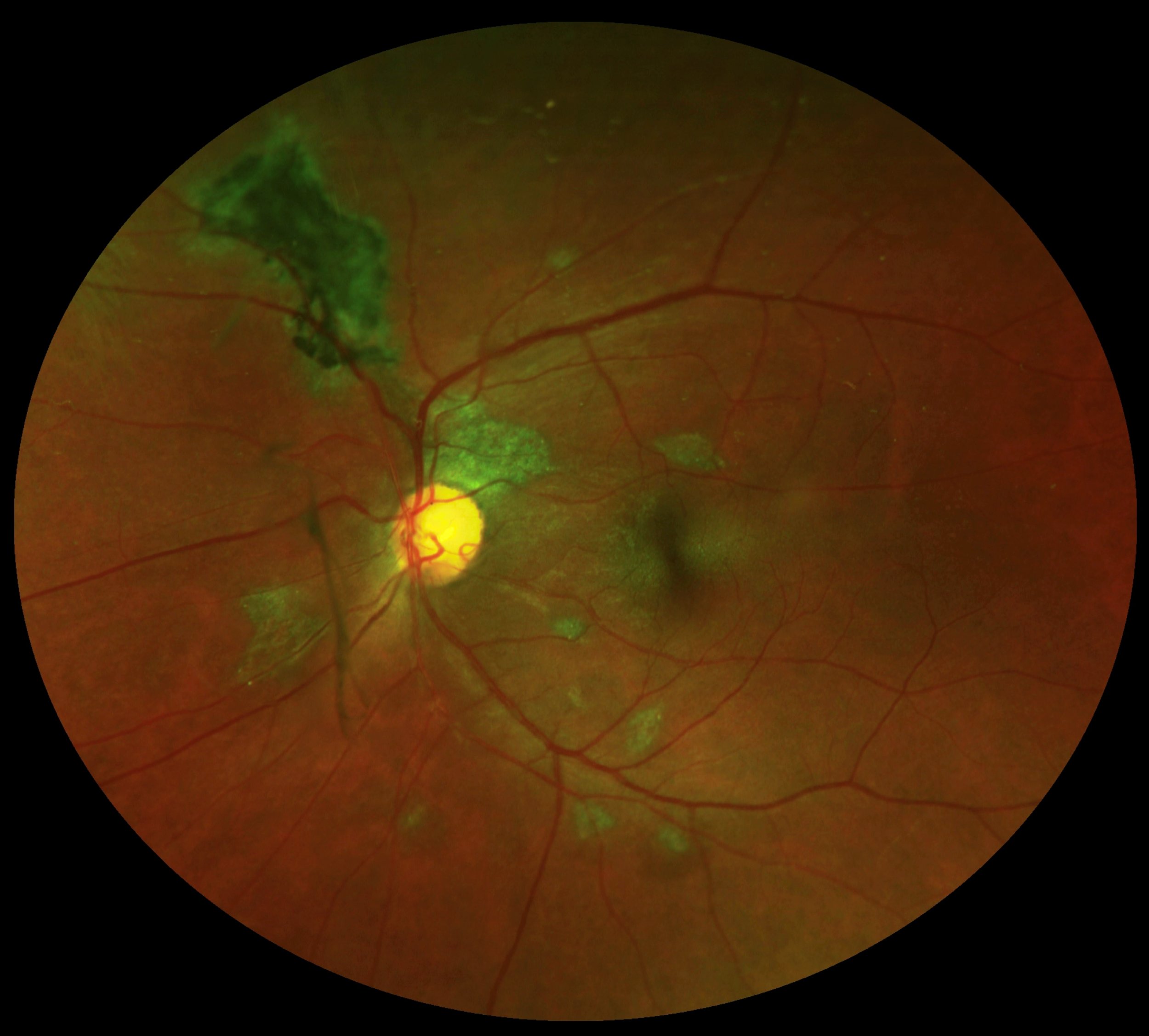 Ebola-retinal-scars