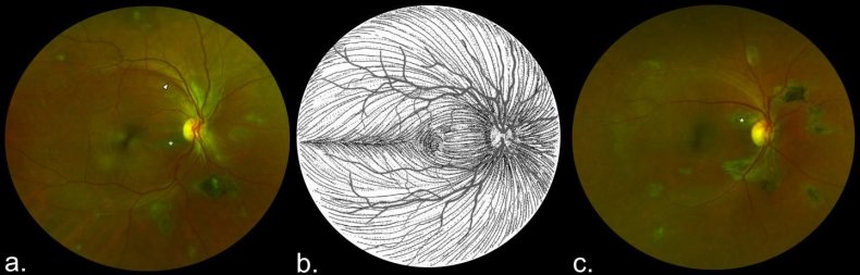 ebola-eye